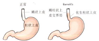 Barrettʳ